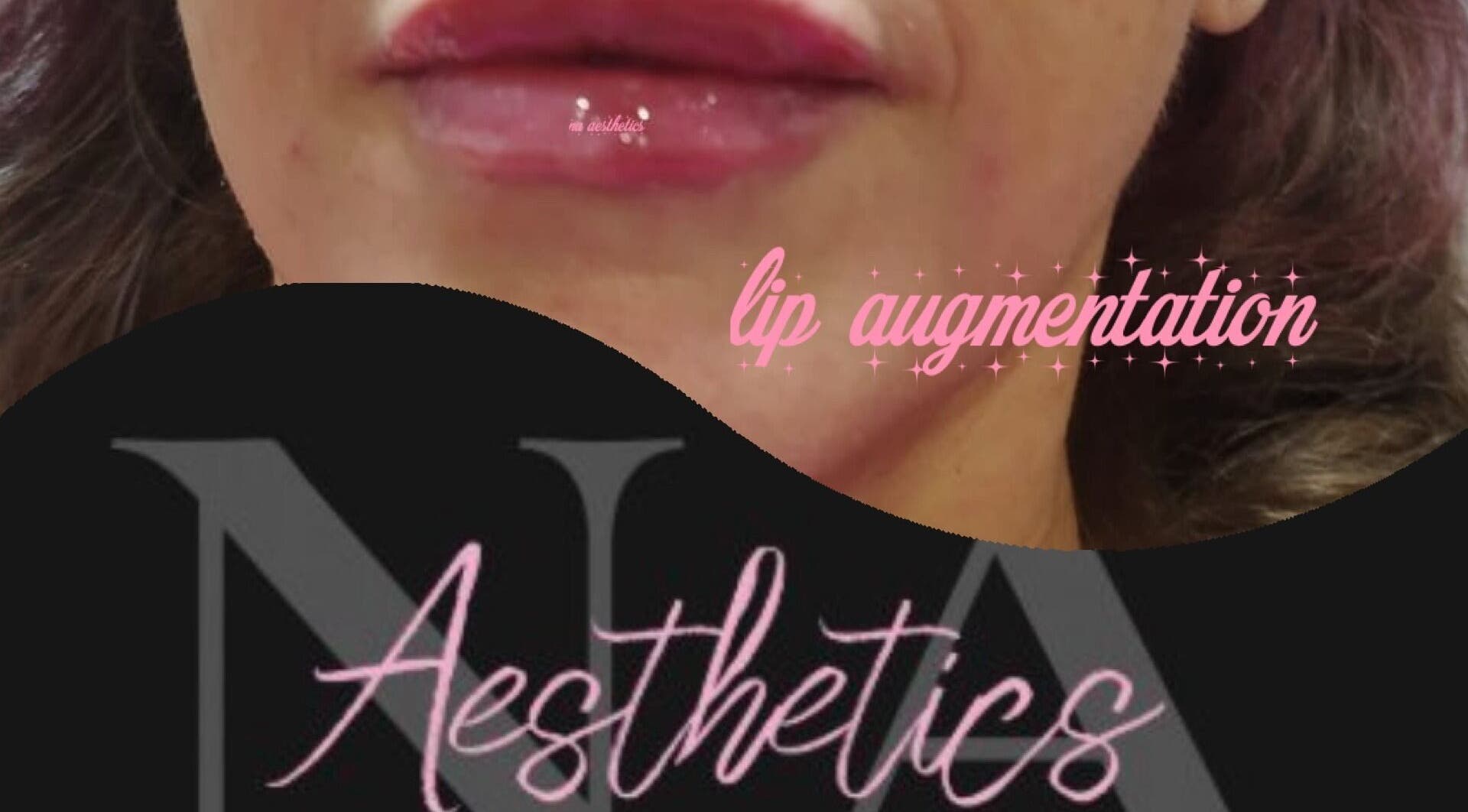 Close-up of lip augmentation at NA aesthetics in Milford Haven, Wales, GB.