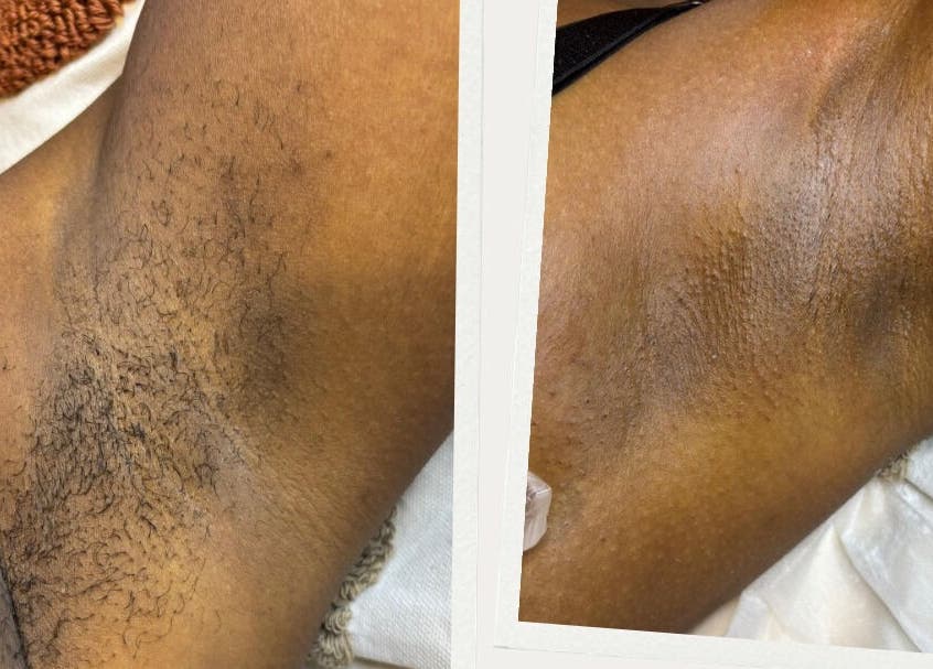 Transformation avant-après épilation, Casa Bella Mar à Toulouse, Occitanie, FR.