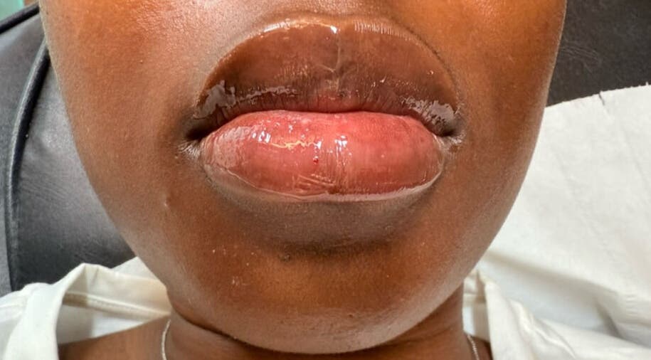 Lip enhancement at Dr Esther Aesthetics, Birmingham, England, GB showcasing glossy, voluminous lips.