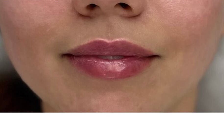 Lip enhancement at A-Derma, Funchal, Madeira, PT showcasing smooth and glossy results.