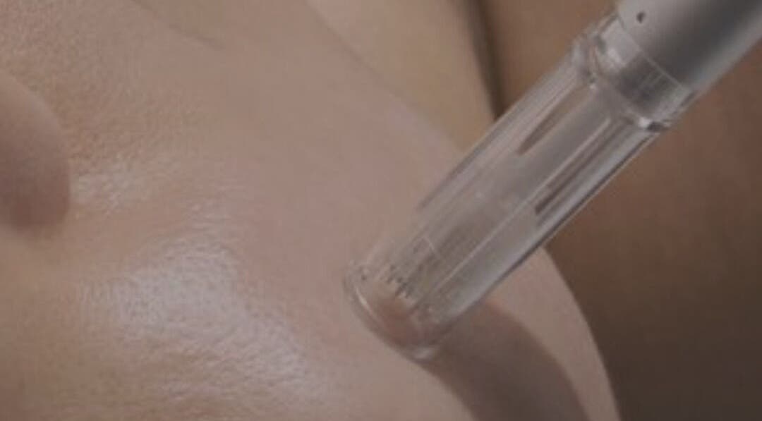 Close-up of professional skin treatment at Èvora Haus skin & Aesthetics in Birmingham, England, GB.