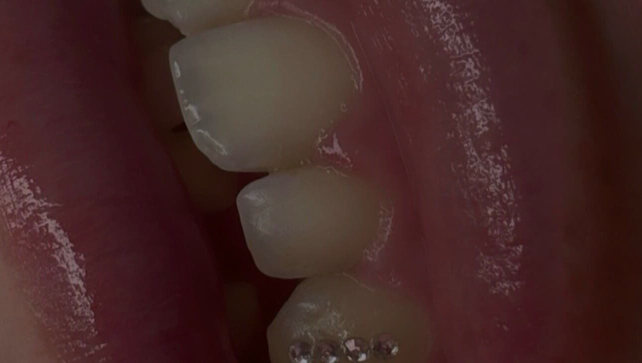 Close-up of decorated teeth at The Beauty Hause, Pacific Pines, Queensland, AU.