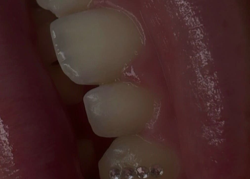 Close-up of decorated teeth at The Beauty Hause, Pacific Pines, Queensland, AU.