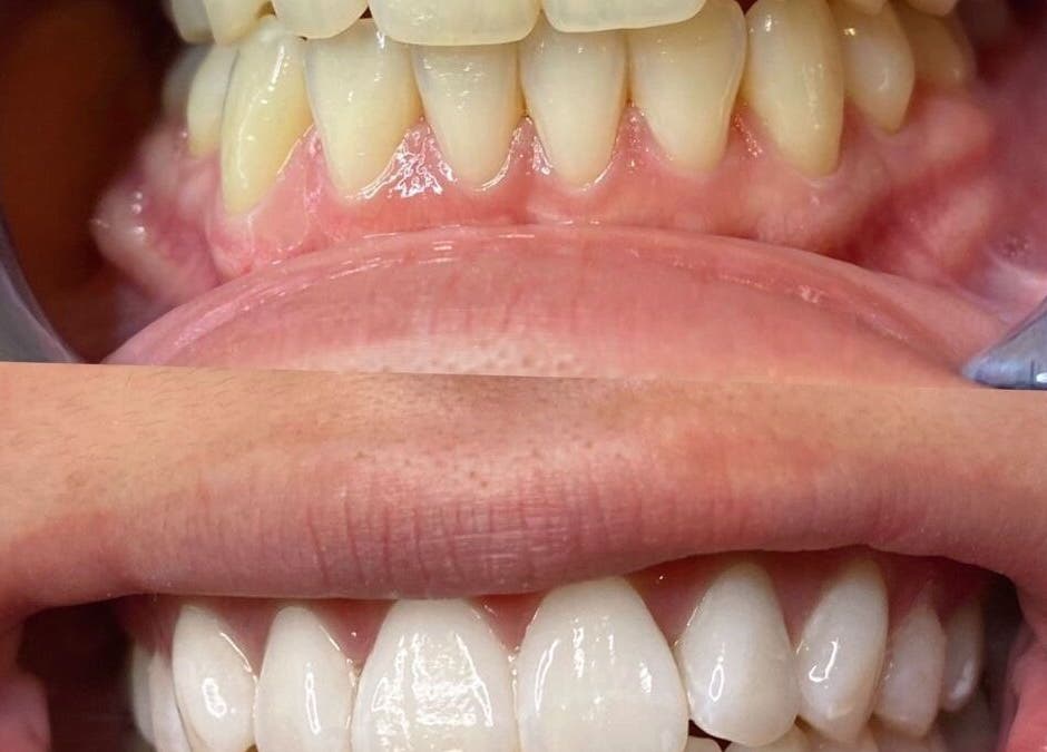 Before and after dental aesthetics at The Beauty Hause, Pacific Pines, Queensland, AU.