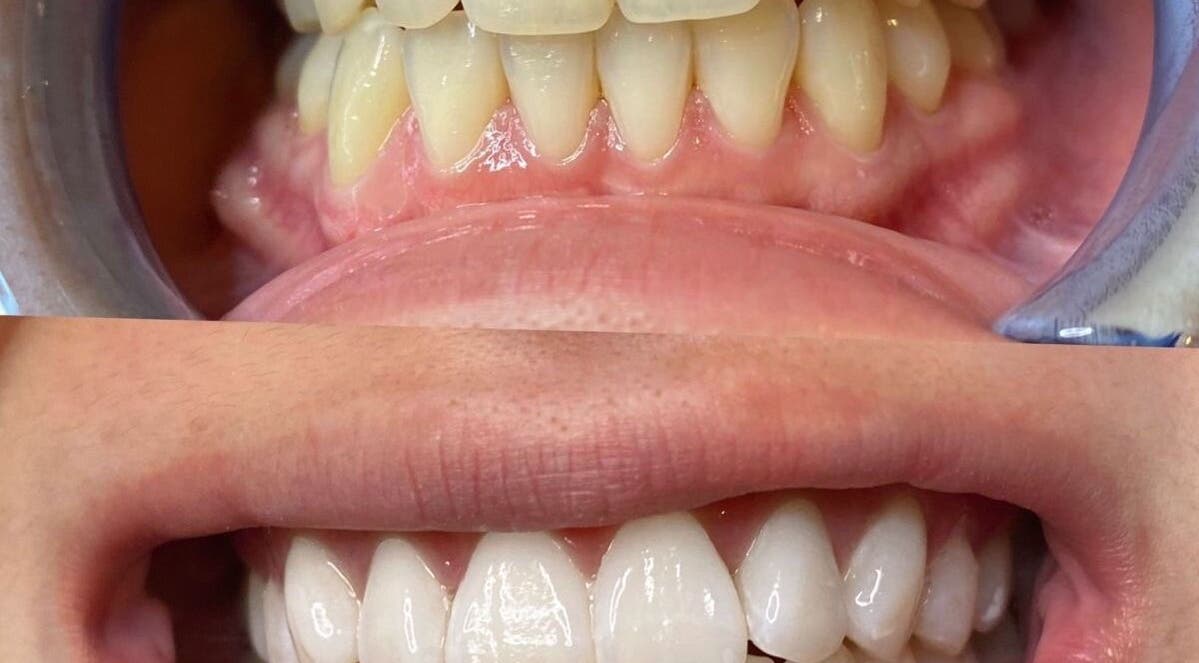 Before and after dental aesthetics at The Beauty Hause, Pacific Pines, Queensland, AU.
