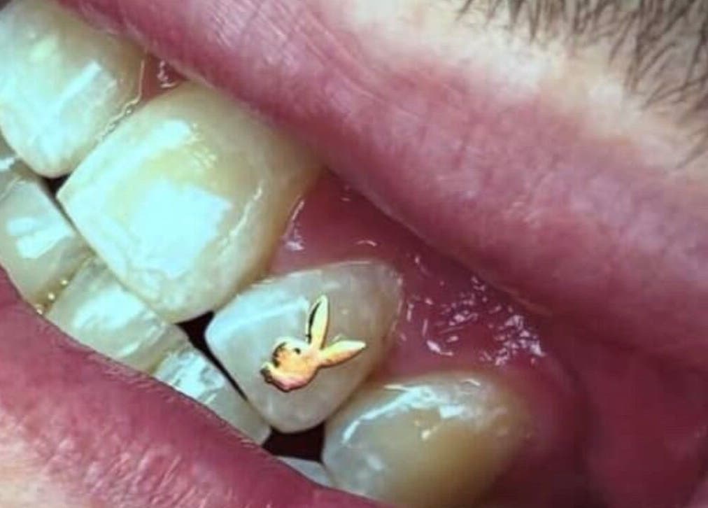 The Beauty Hause custom tooth design with gold detail in Pacific Pines, Queensland, AU.