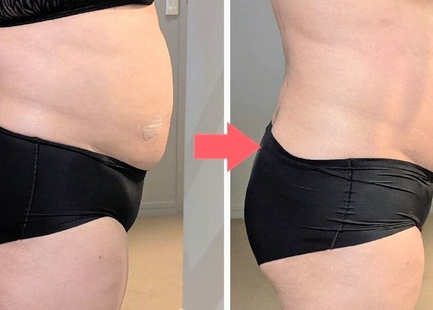 Before and after body contouring at Total Body Care Salon BLESS, Auckland, Auckland, NZ.