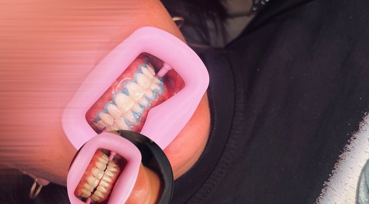 Blanchiment dentaire chez Life beauty, Vienne, Auvergne-rhône-alpes, FR, pour un sourire éclatant.