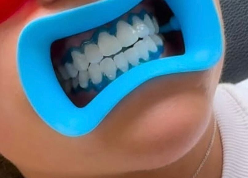 Teeth whitening session at Cecilianahair, Manchester, England, GB showcasing blue mouthpiece.
