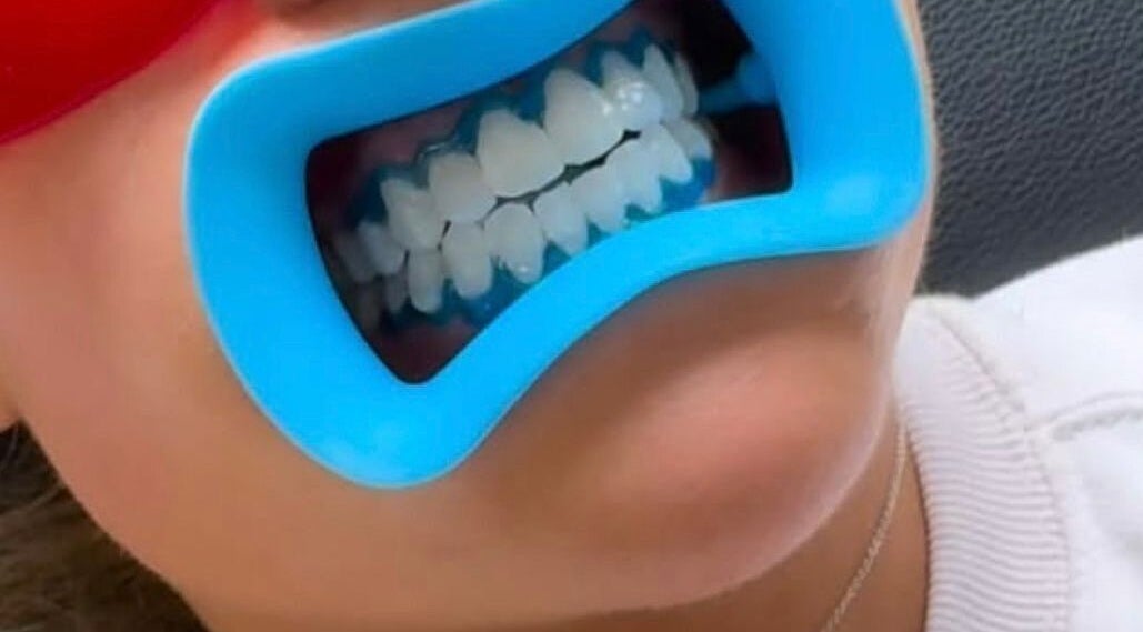 Teeth whitening session at Cecilianahair, Manchester, England, GB showcasing blue mouthpiece.