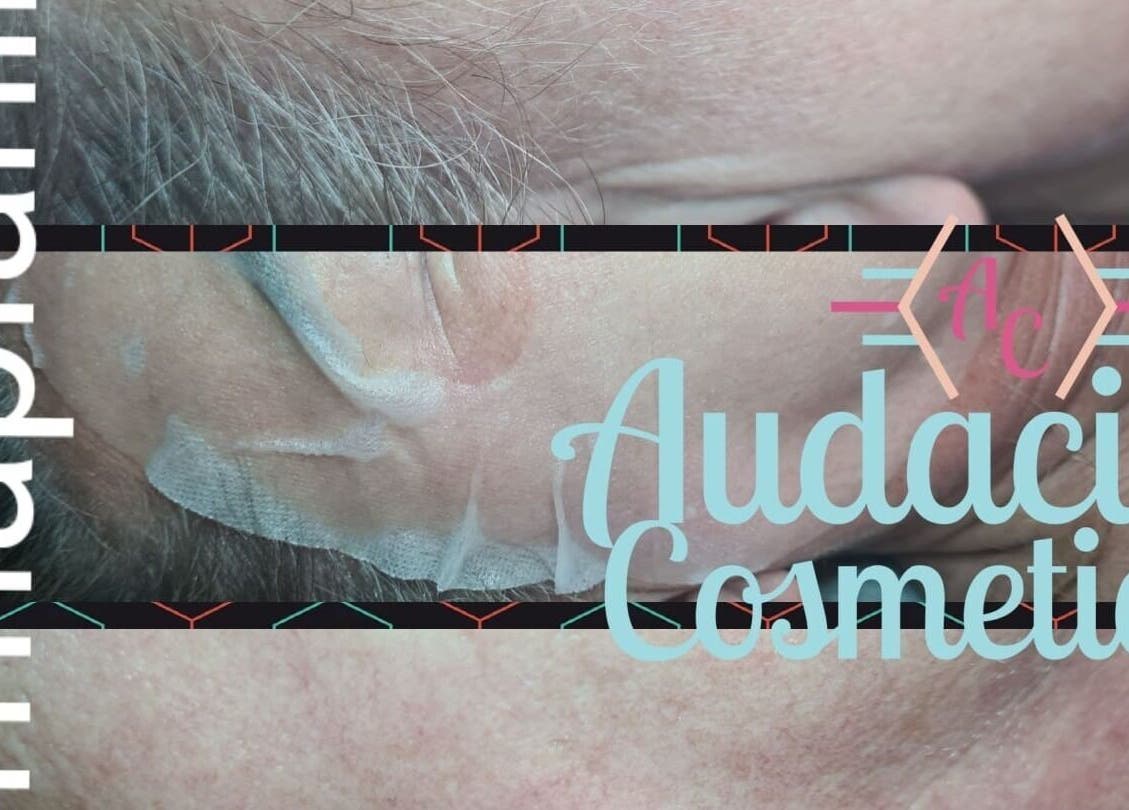 Dermaplaning treatment at R J Aesthetics in Thornton-cleveleys, England enhances skin texture visibly.