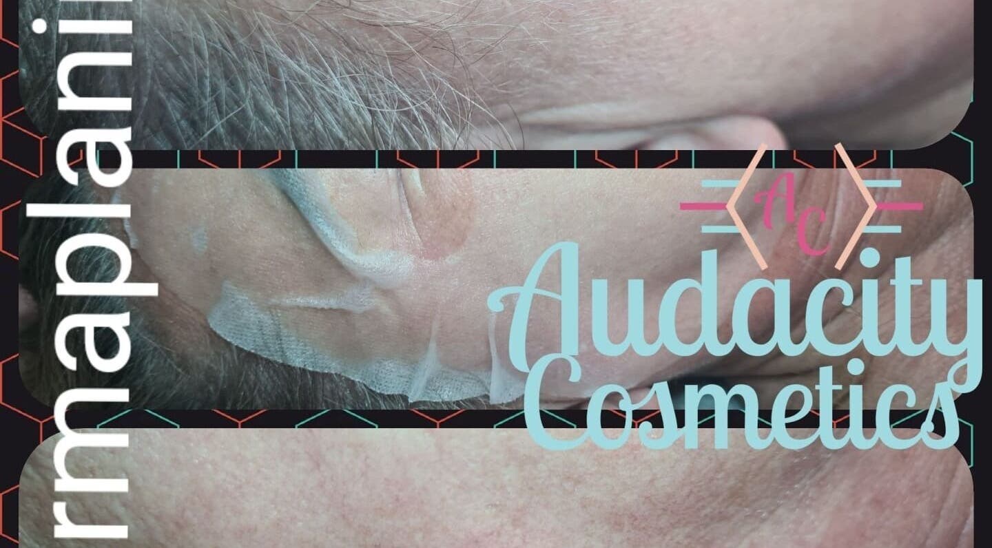 Dermaplaning treatment at R J Aesthetics in Thornton-cleveleys, England enhances skin texture visibly.