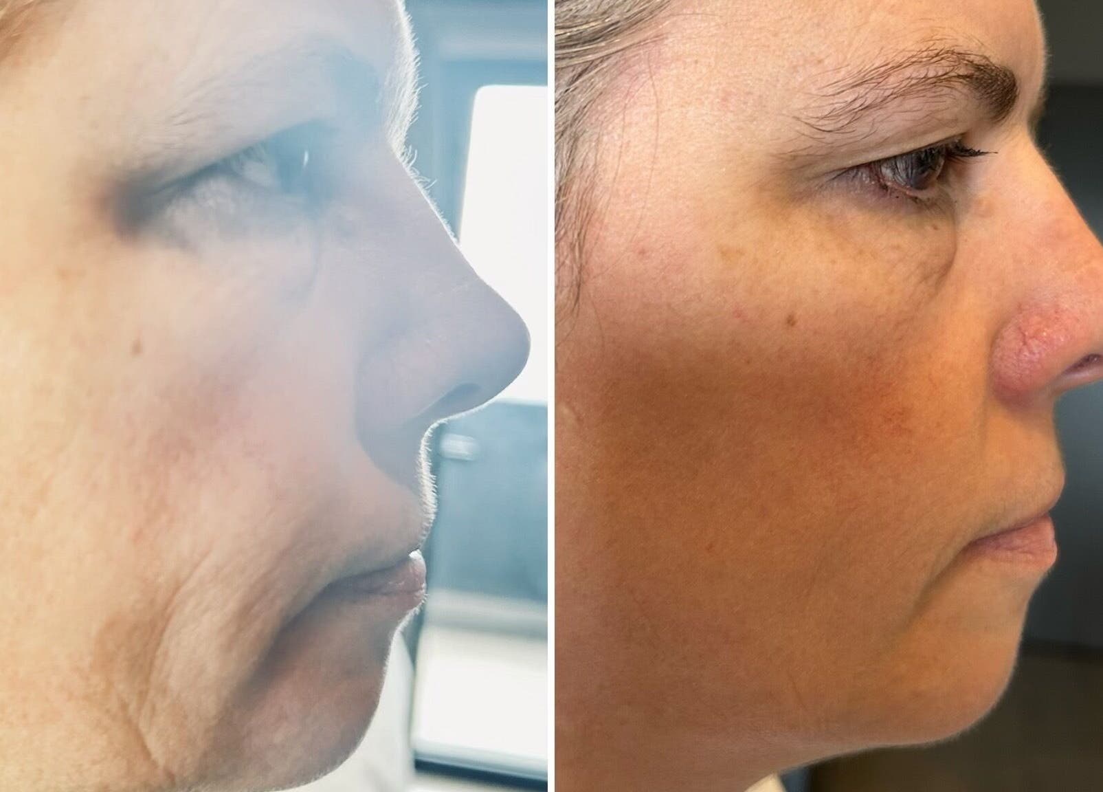 Before and after skin treatment at Skincare & Aesthetics Clinic, Pretoria, Gauteng, ZA.