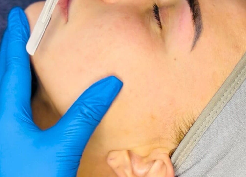 Dermaplaning treatment at Skincare & Aesthetics Clinic, Pretoria, Gauteng, ZA for smooth, rejuvenated skin.