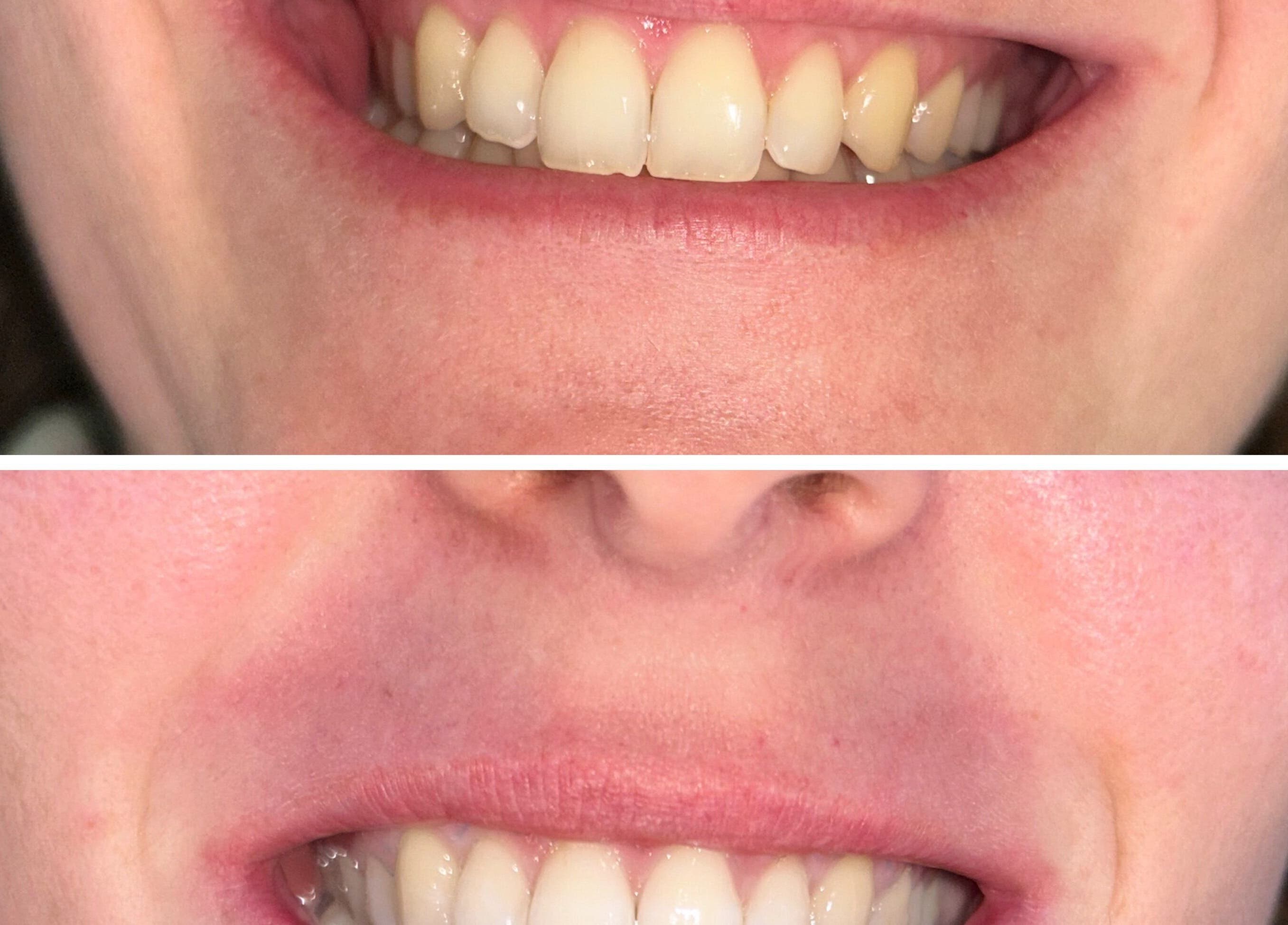 Avant et après blanchiment dentaire à Maison Amoria, Draguignan, Provence-Alpes-Côte d'Azur, FR.