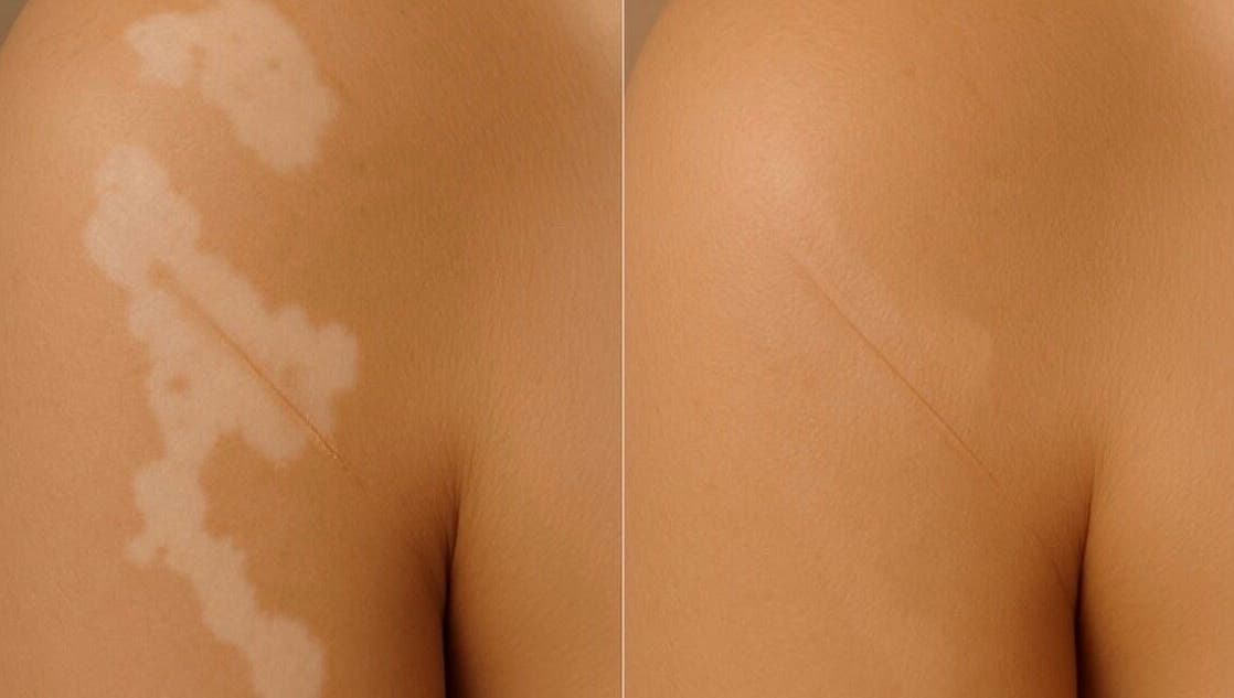 Before and after skin treatment at Dermal Ink Institute, Aveley, Western Australia, AU.