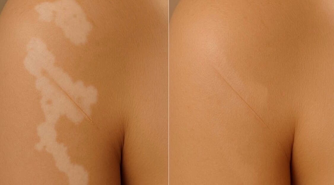 Before and after skin treatment at Dermal Ink Institute, Aveley, Western Australia, AU.