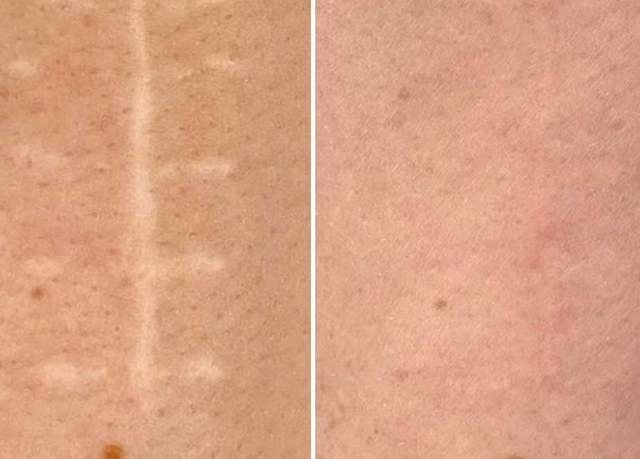 Before and after scar treatment at Dermal Ink Institute, Aveley, Western Australia, AU showing smooth skin results.