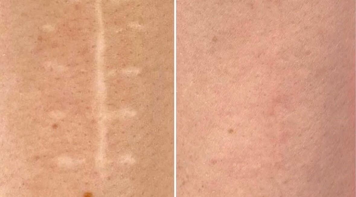 Before and after scar treatment at Dermal Ink Institute, Aveley, Western Australia, AU showing smooth skin results.