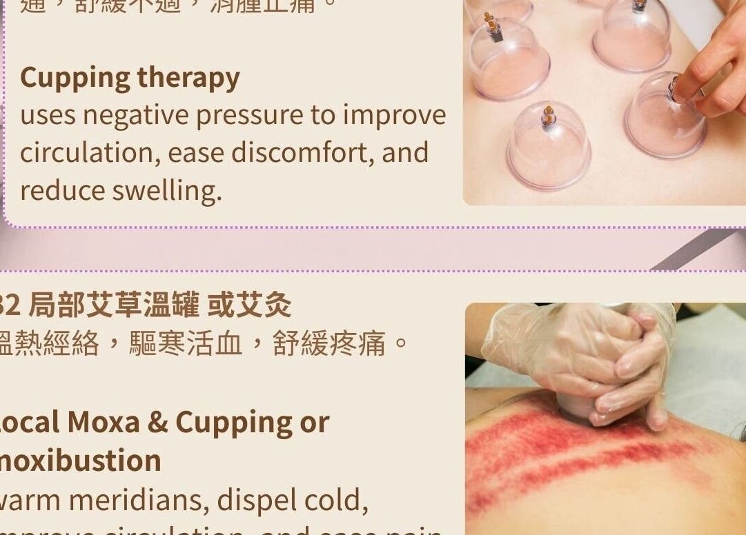 Cupping therapy at Harmony River Studio, Auckland, NZ, promoting circulation and reducing swelling.