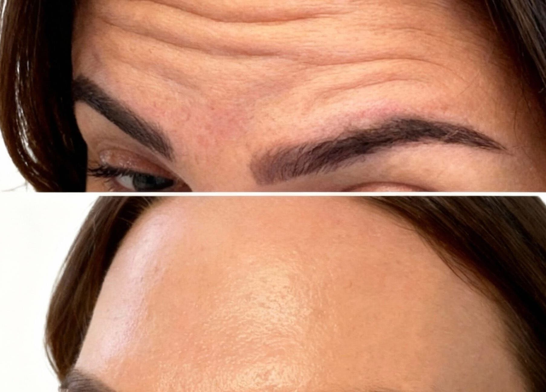 Before and after forehead treatment at Aura Skinn By Sandra, Buckhurst Hill, England, GB.
