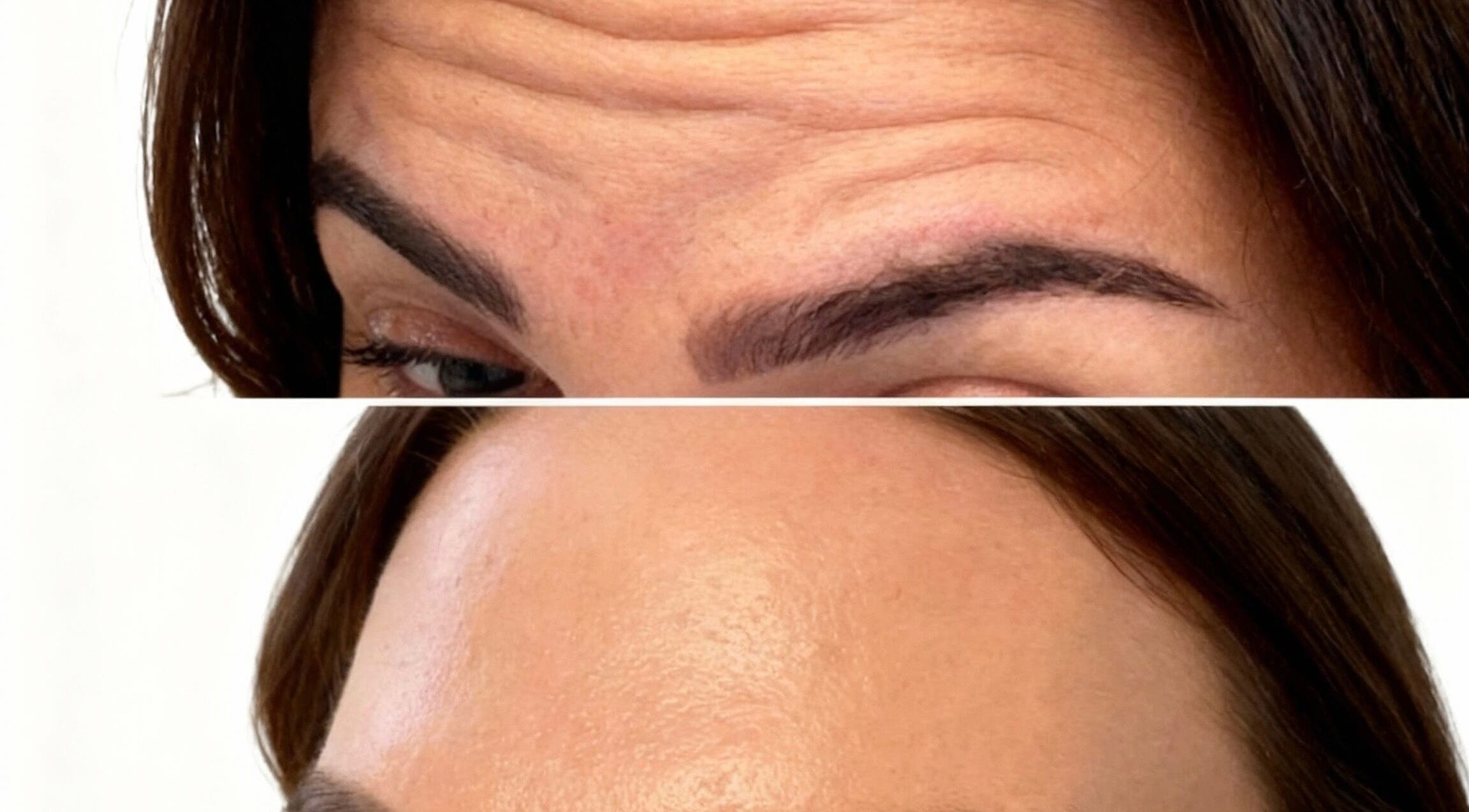 Before and after forehead treatment at Aura Skinn By Sandra, Buckhurst Hill, England, GB.