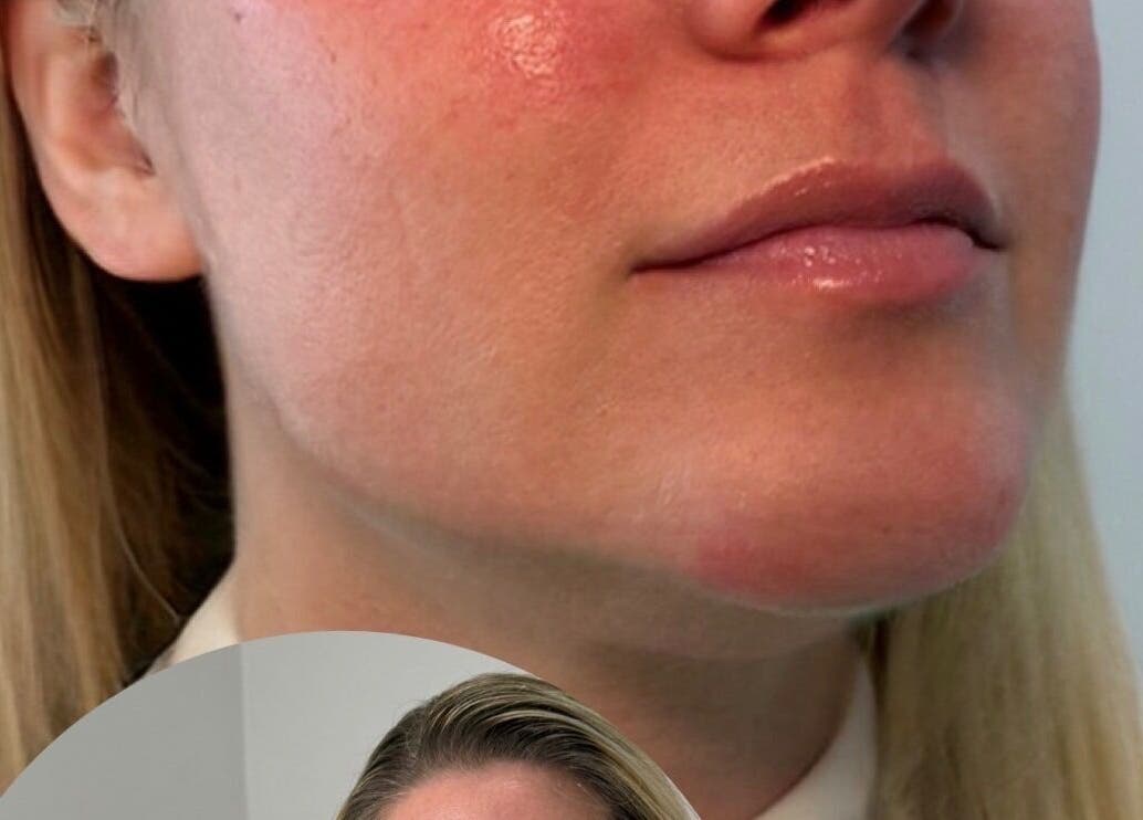 Close-up of glowing skin after treatment at Aura Skinn By Sandra, Buckhurst Hill, England, GB.