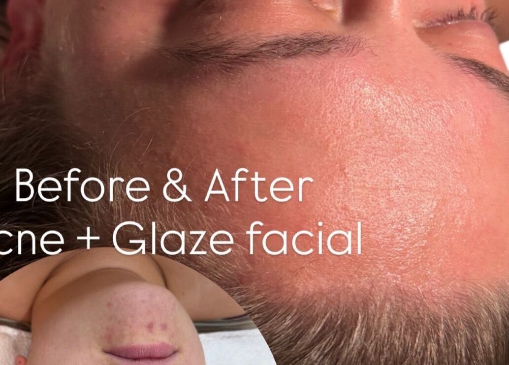Before and after acne facial at Aura Skinn By Sandra in Buckhurst Hill, England, GB.