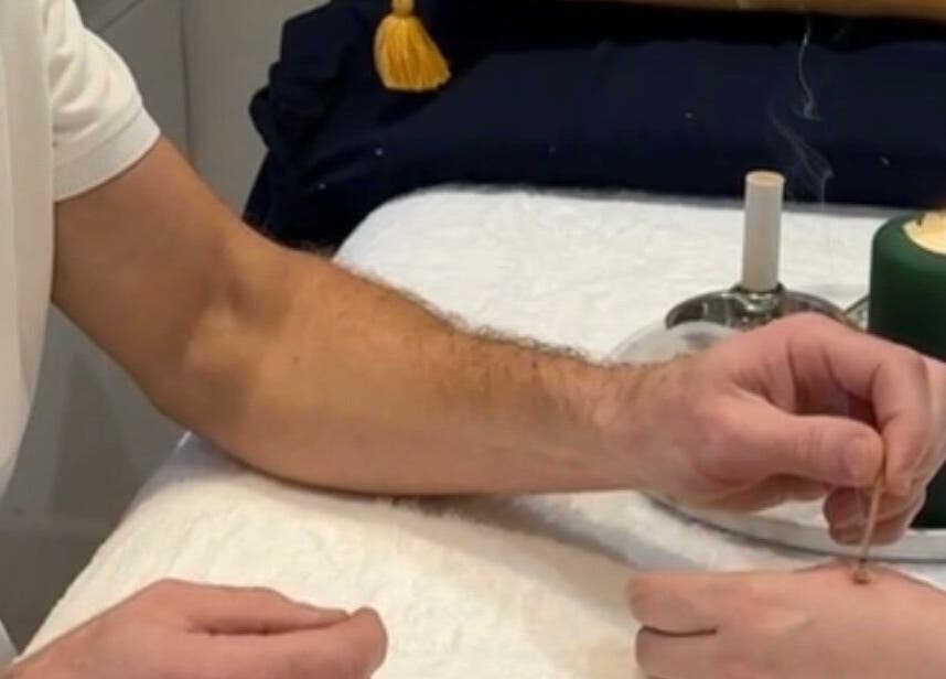 Acupuncture session in progress at The Avenue Acupuncture Clinic, Worcester, England, GB.