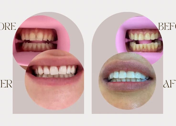 Résultats avant-après du blanchiment dentaire chez Glow Smile Studio, Prilly, Vaud, CH.