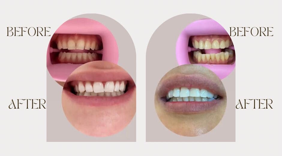 Résultats avant-après du blanchiment dentaire chez Glow Smile Studio, Prilly, Vaud, CH.