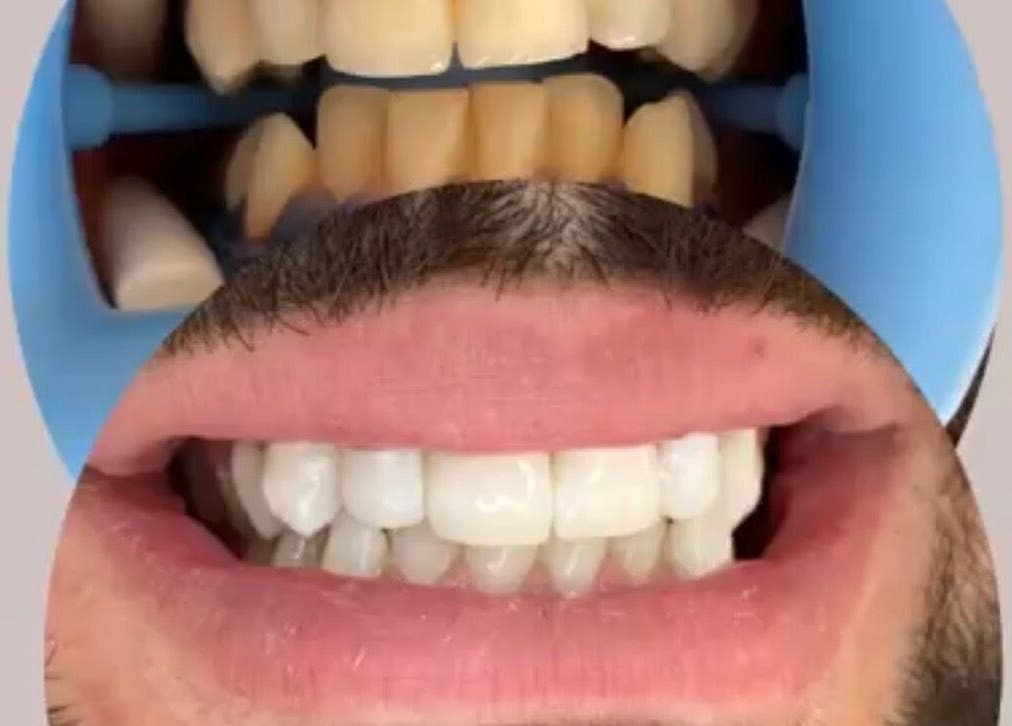 Traitement dentaire à Glow Smile Studio à Prilly, Vaud, CH, montrant avant et après des dents blanches.