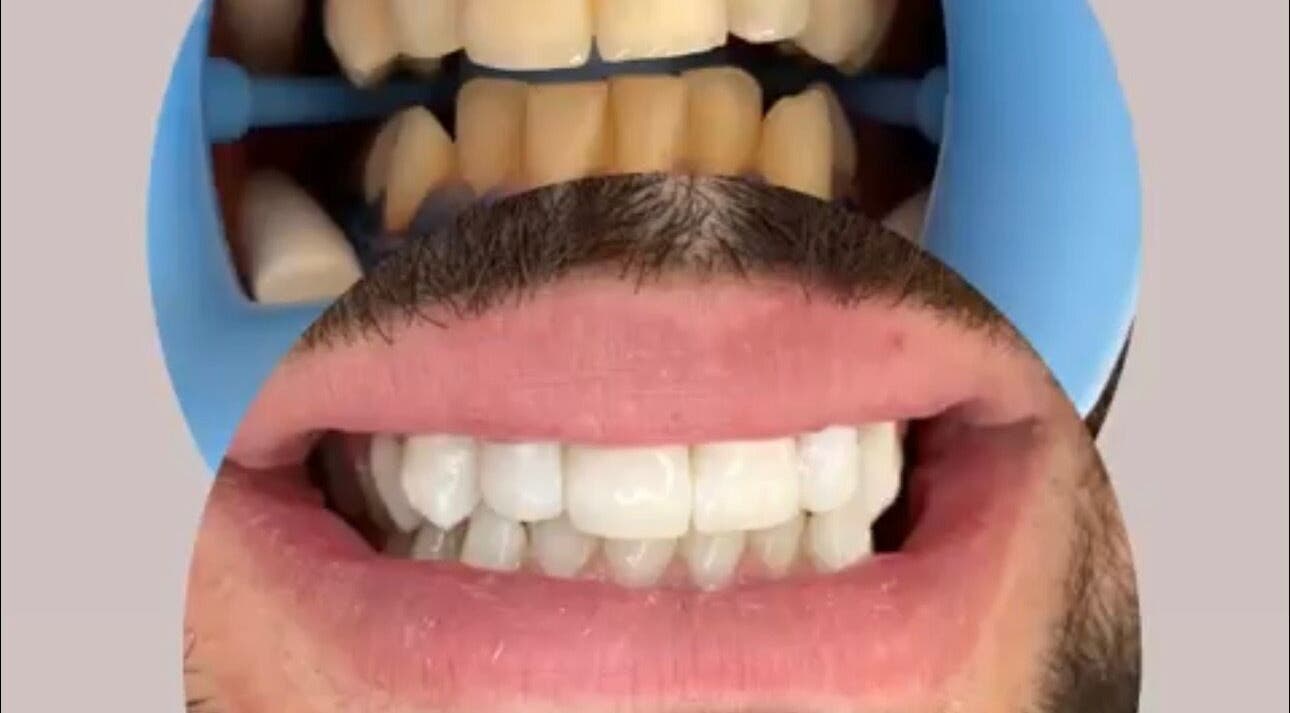 Traitement dentaire à Glow Smile Studio à Prilly, Vaud, CH, montrant avant et après des dents blanches.