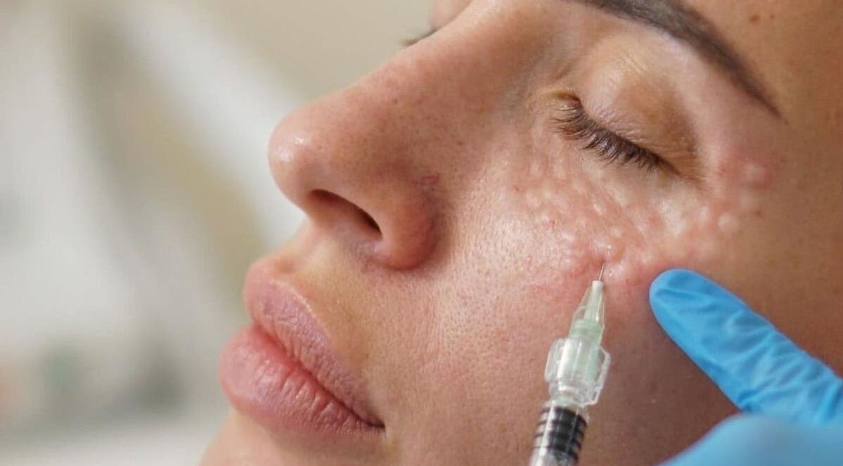 Zabieg iniekcji w Aesthetic Center- Patrycja Biernat, Pępowo, Województwo Pomorskie, PL.