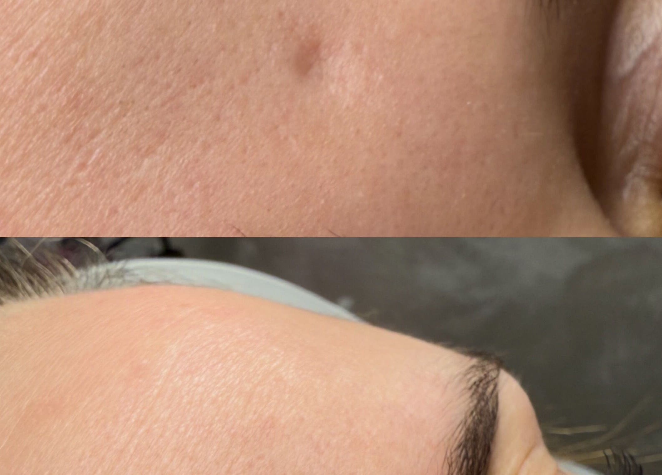 Przed i po zabiegu skóry w Aesthetic Center- Patrycja Biernat, Pępowo, Województwo Pomorskie, PL.