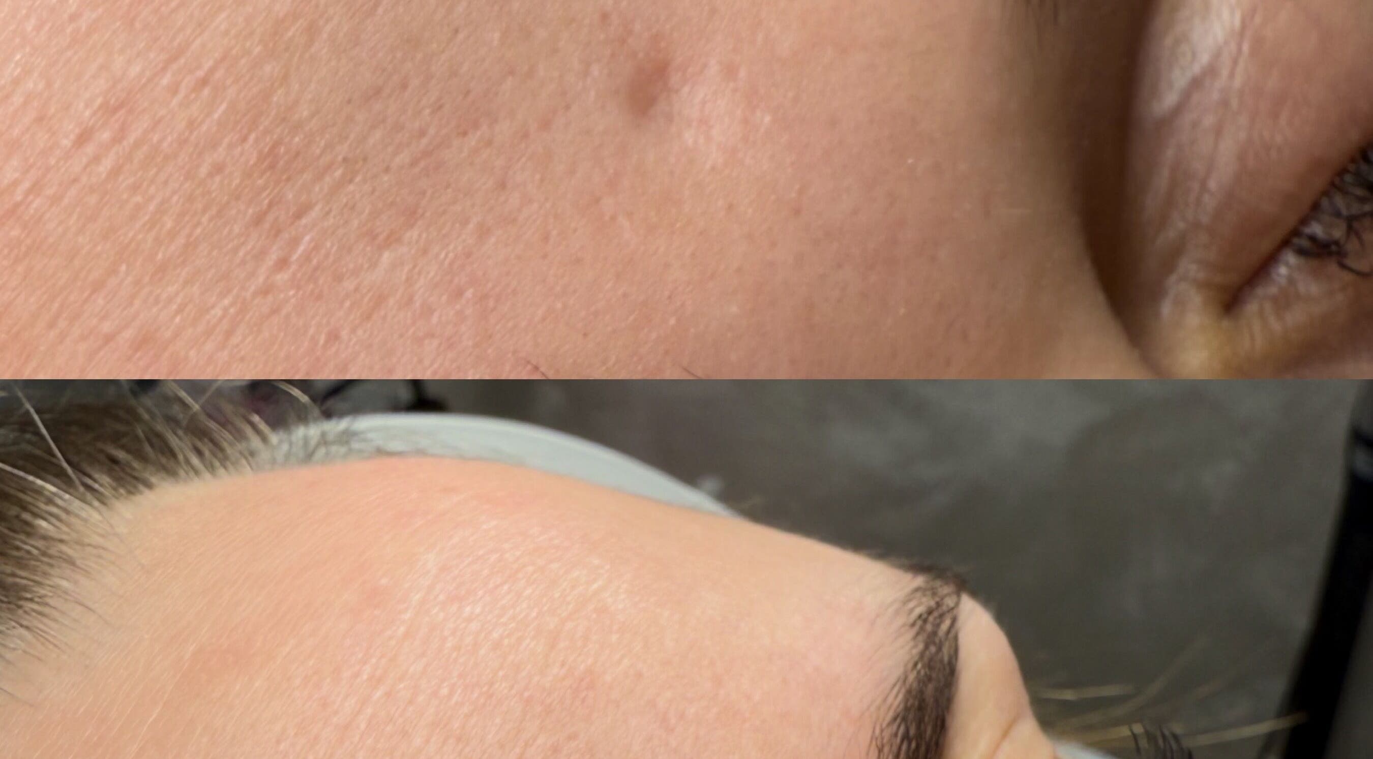 Przed i po zabiegu skóry w Aesthetic Center- Patrycja Biernat, Pępowo, Województwo Pomorskie, PL.