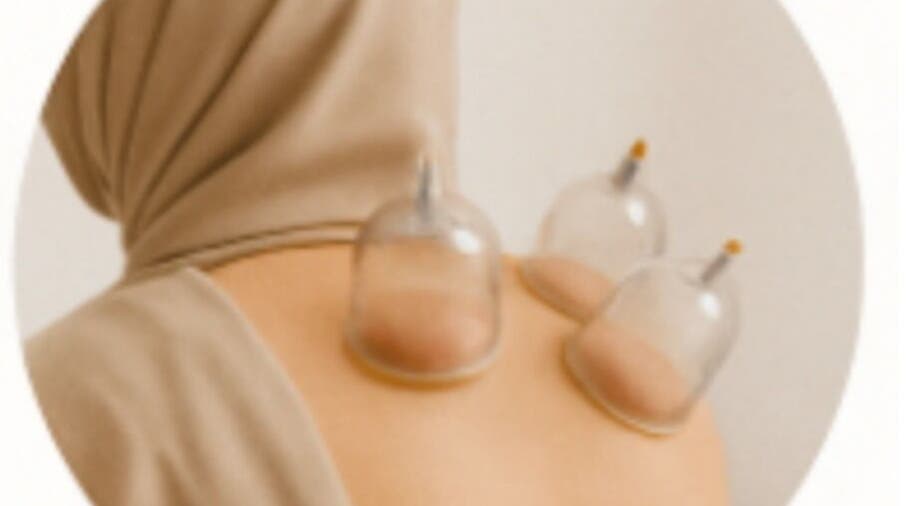 Cupping therapy session at Purecups Wellness Therapy, Oxford, England, GB.
