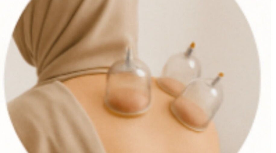 Cupping therapy session at Purecups Wellness Therapy, Oxford, England, GB.