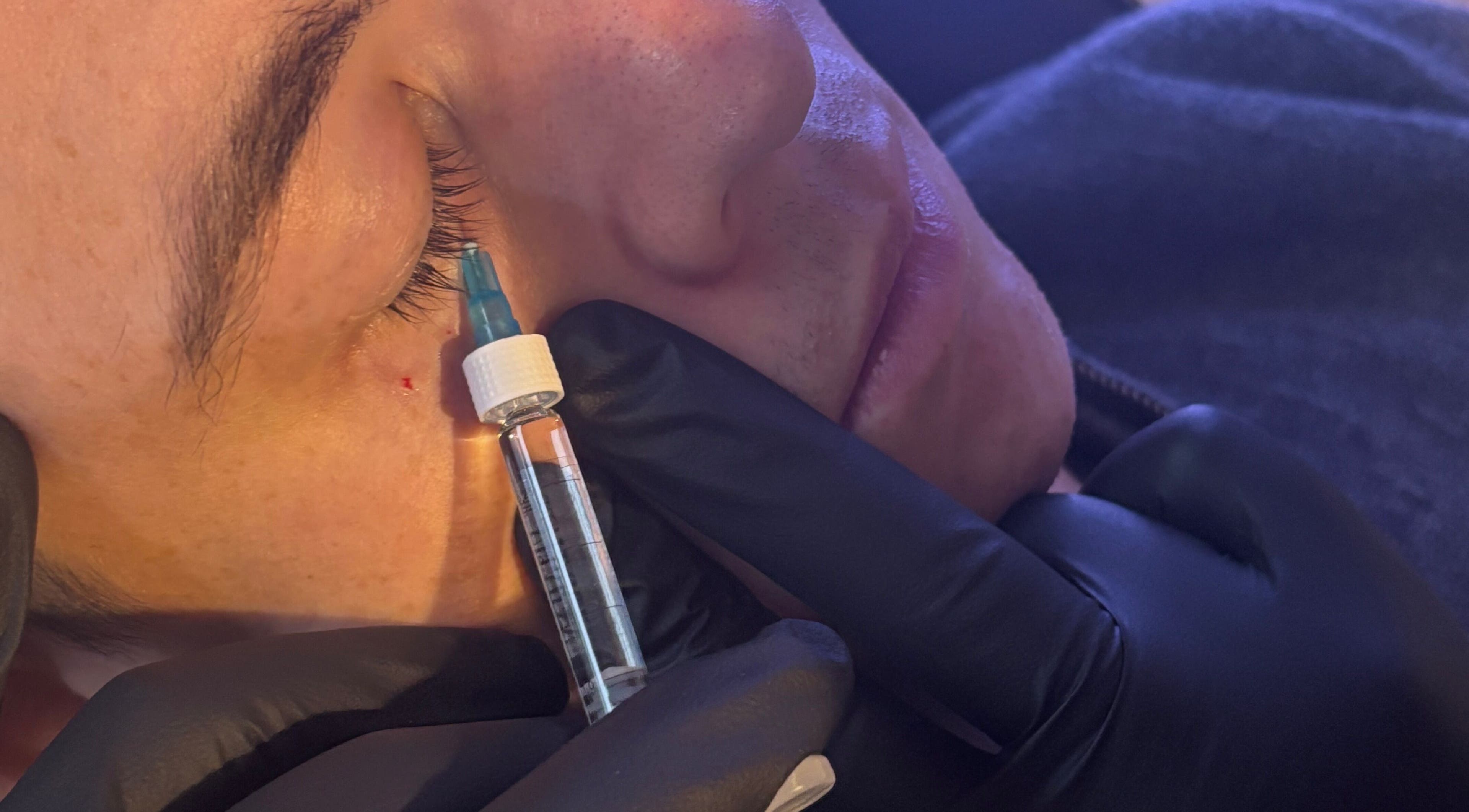 Close-up of a cosmetic treatment at Apricity Healthcare, Bristol, England, GB, emphasizing precision and care.