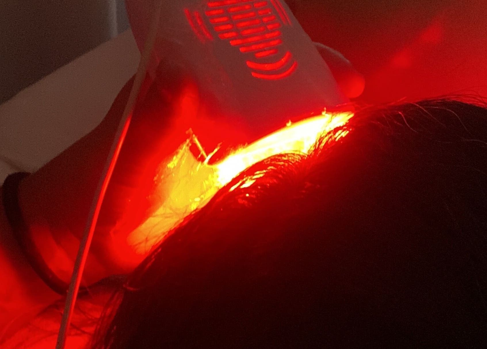 Tratamento a laser no cabelo na Fio Hair Clínica em Portimão, Faro, PT.