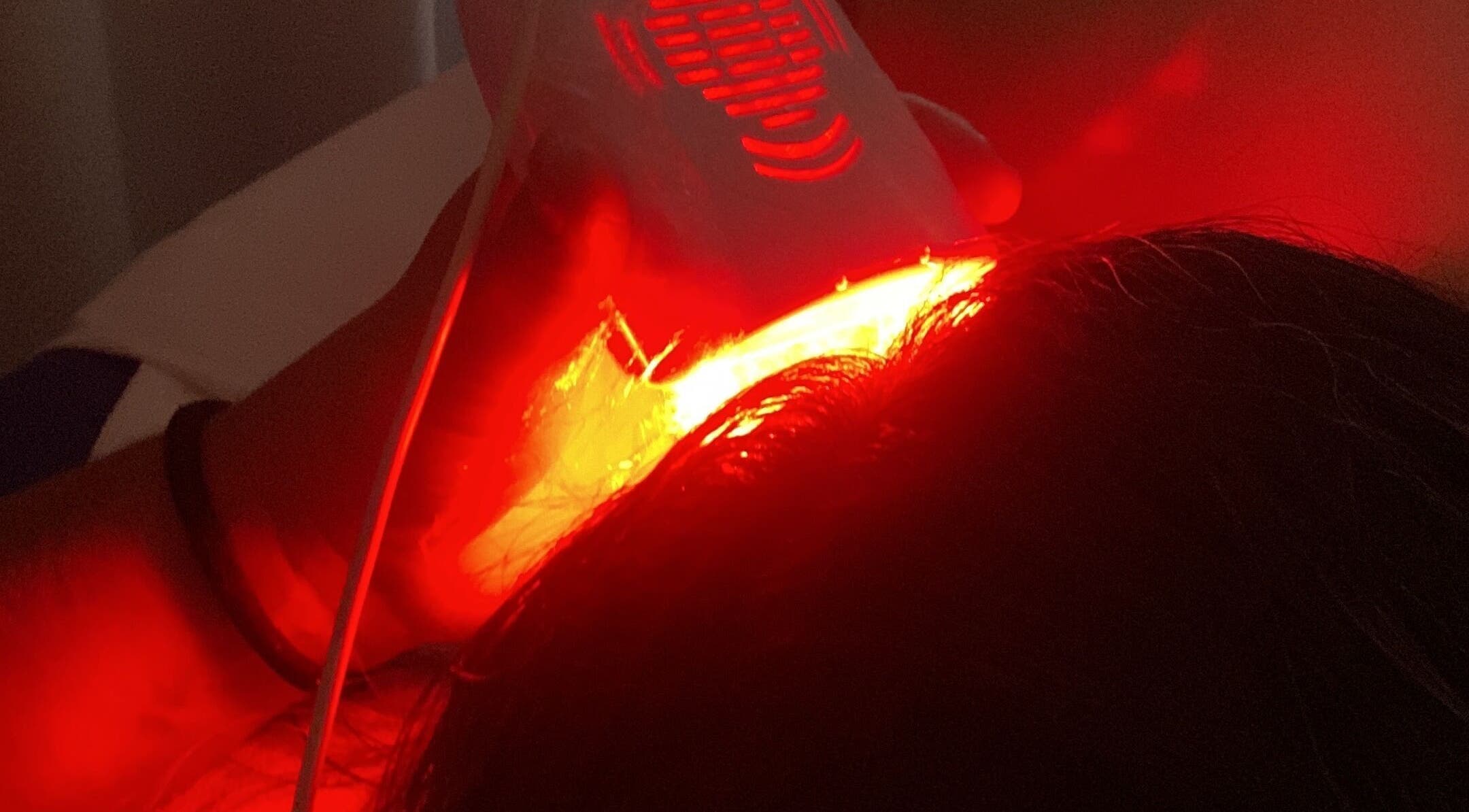 Tratamento a laser no cabelo na Fio Hair Clínica em Portimão, Faro, PT.