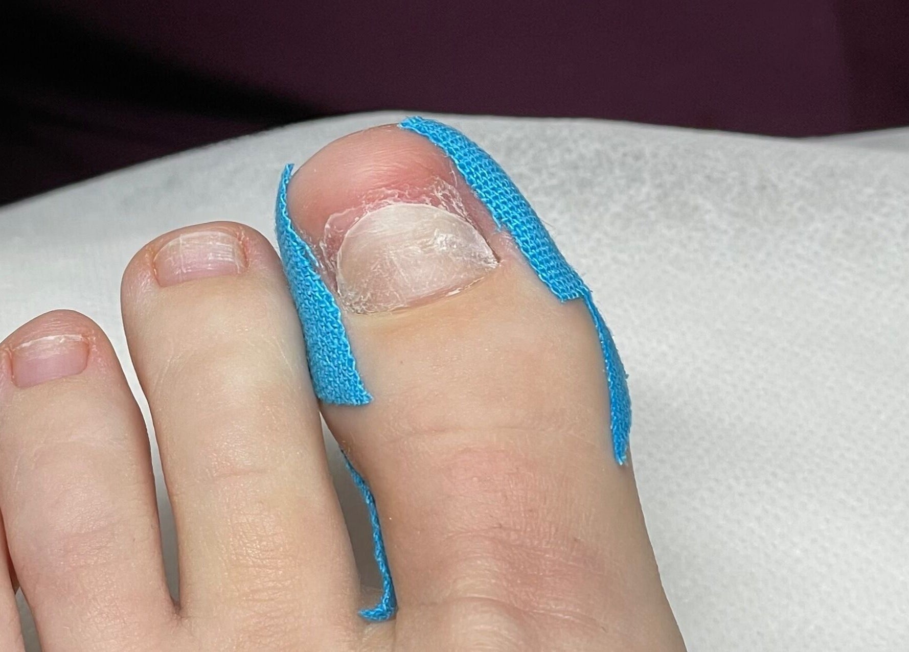 Close-up of a foot receiving a podiatry treatment at Mariam.Podo, Amman, Amman Governorate, JO.