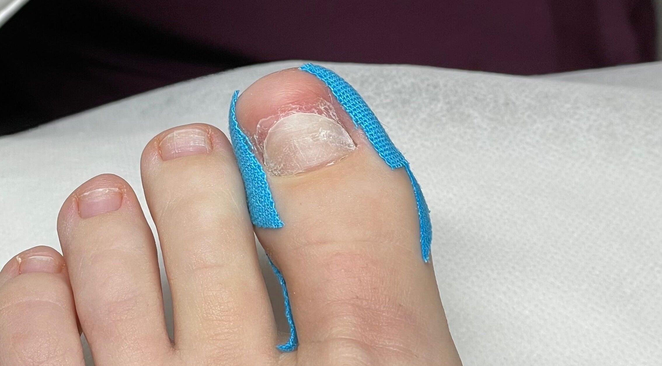 Close-up of a foot receiving a podiatry treatment at Mariam.Podo, Amman, Amman Governorate, JO.