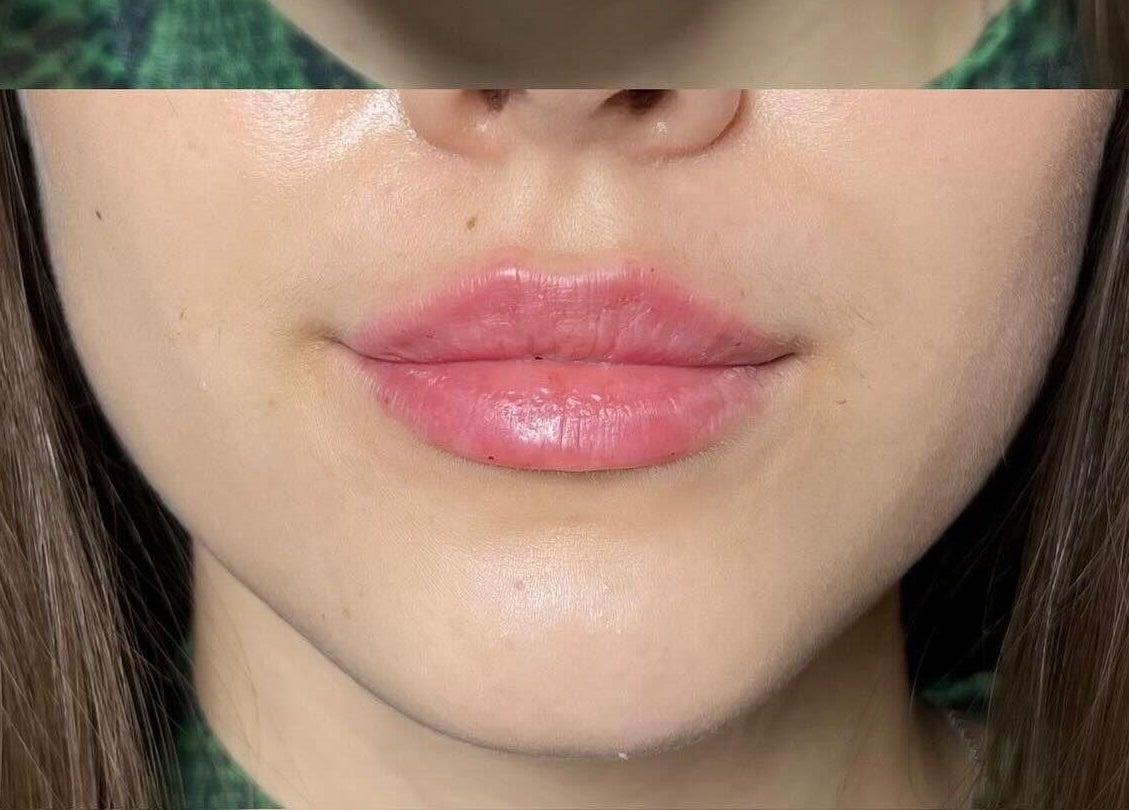 Close-up of enhanced lips at Elya Aesthetic, London, England, GB showcasing expert beauty treatment.