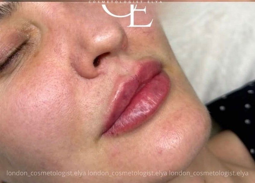 Close-up of rejuvenated skin after treatment at Elya Aesthetic, London, England, GB.
