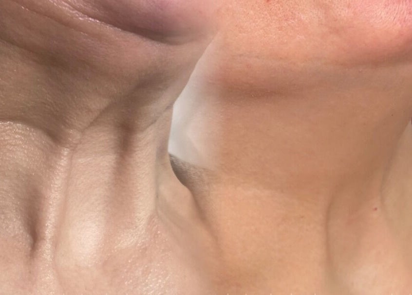 Before and after neck treatment at Elya Aesthetic, London, England, GB highlighting skin improvement.