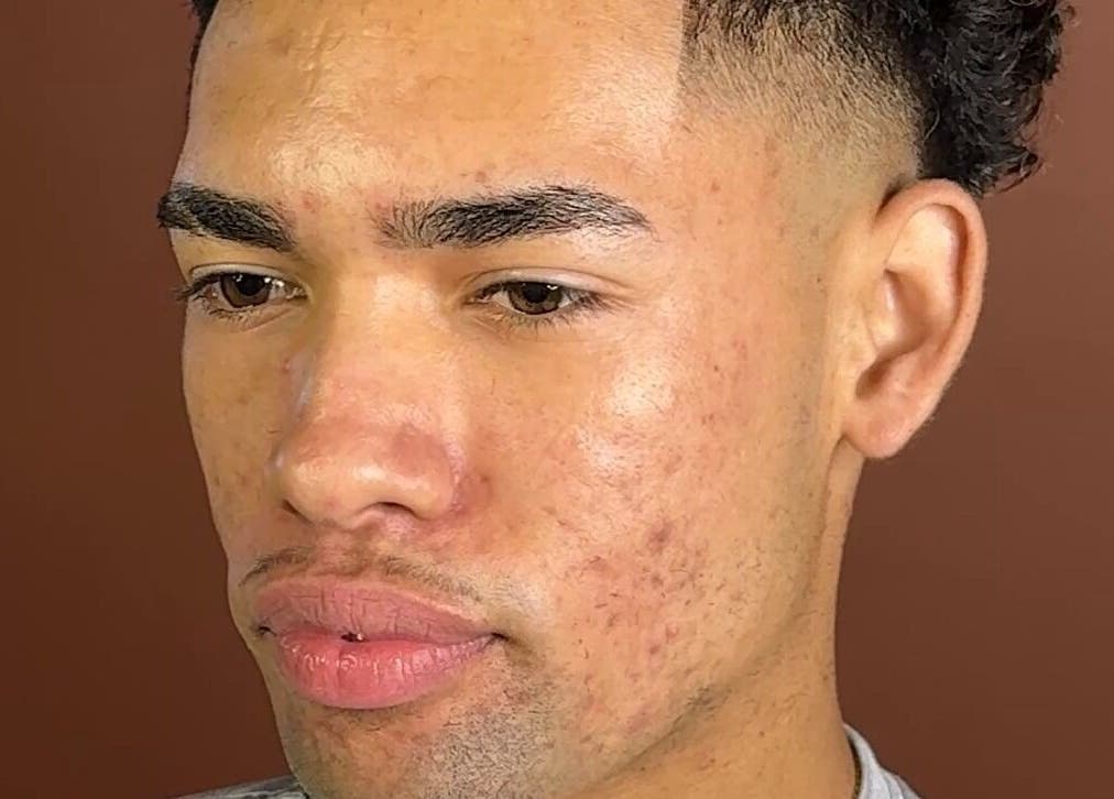 Close-up of a client's clear skin treatment at Velor Studio, Waterloo, Ontario, CA.