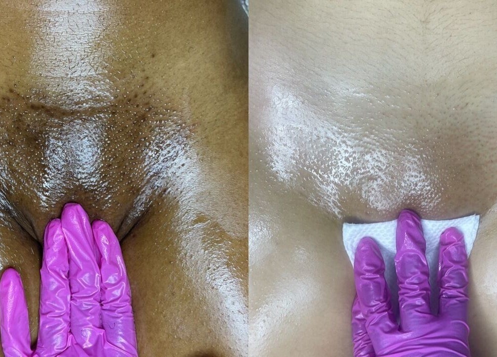 Skin treatment at Bare Luxe, Downtown, New Orleans, Louisiana, US showing smooth results.