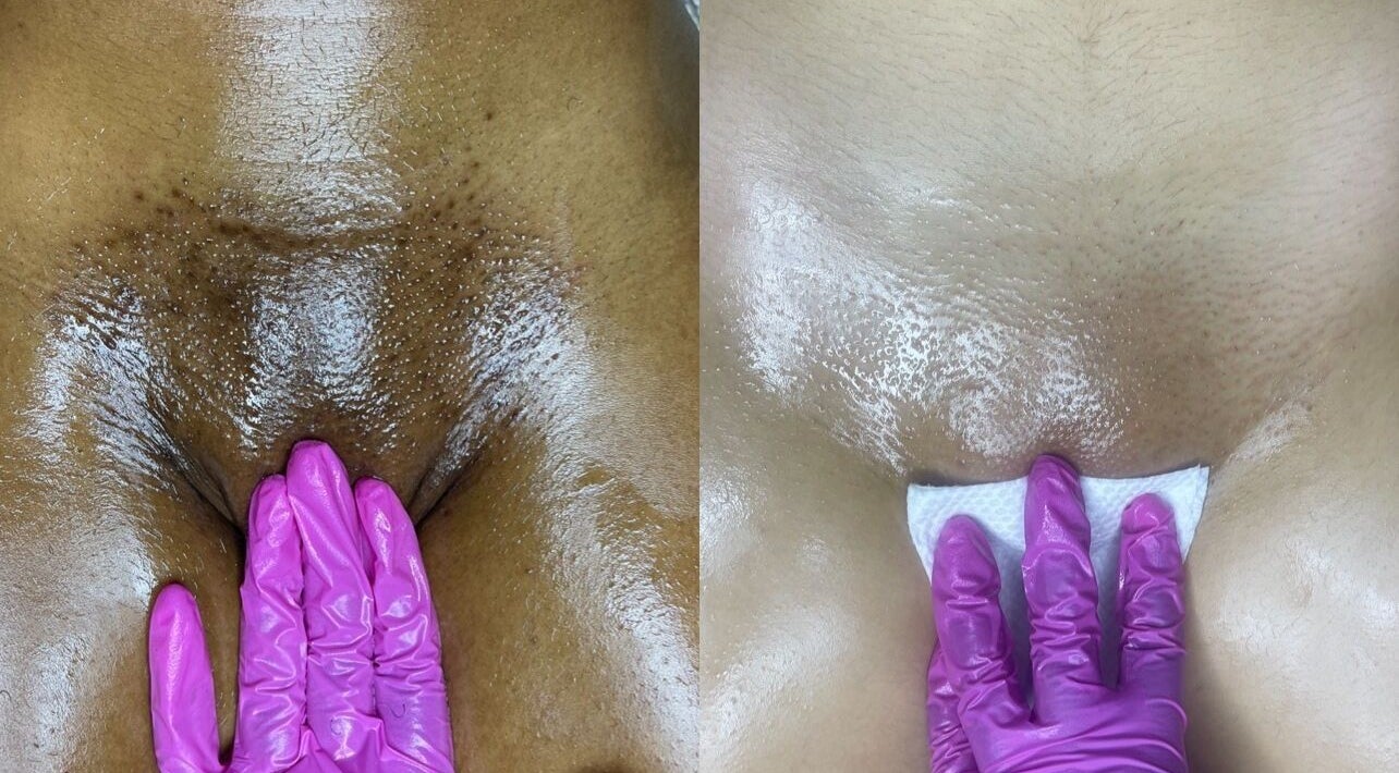 Skin treatment at Bare Luxe, Downtown, New Orleans, Louisiana, US showing smooth results.
