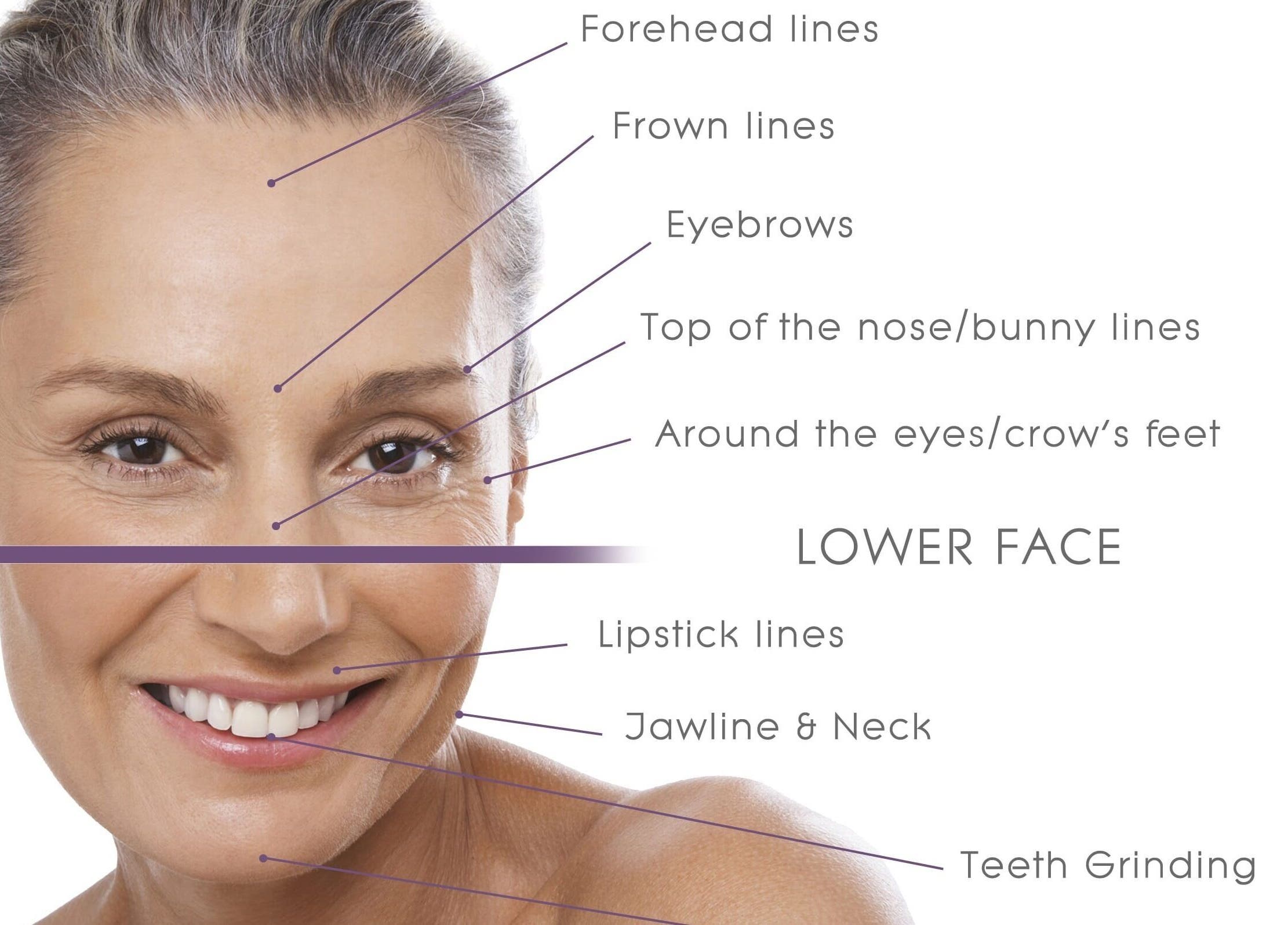 Facial lines diagram at NovaSkin, County Kilkenny, IE, highlighting treatment areas for skincare.